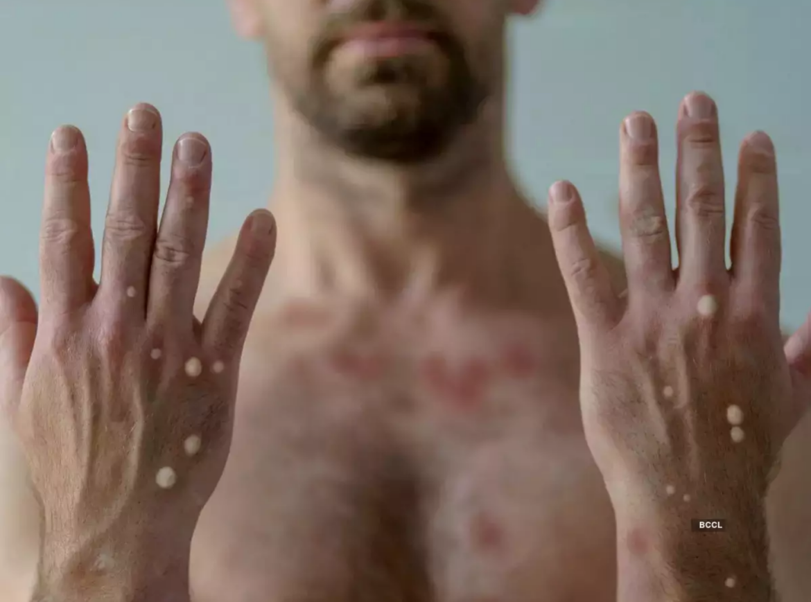 Viruela del mono es emergencia de salud mundial mpox en houston