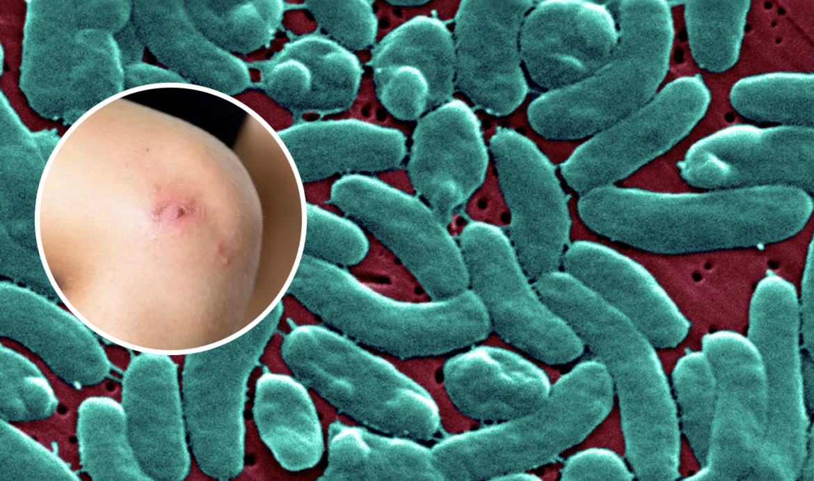 BACTERIACOMECARNE Parásito come carne