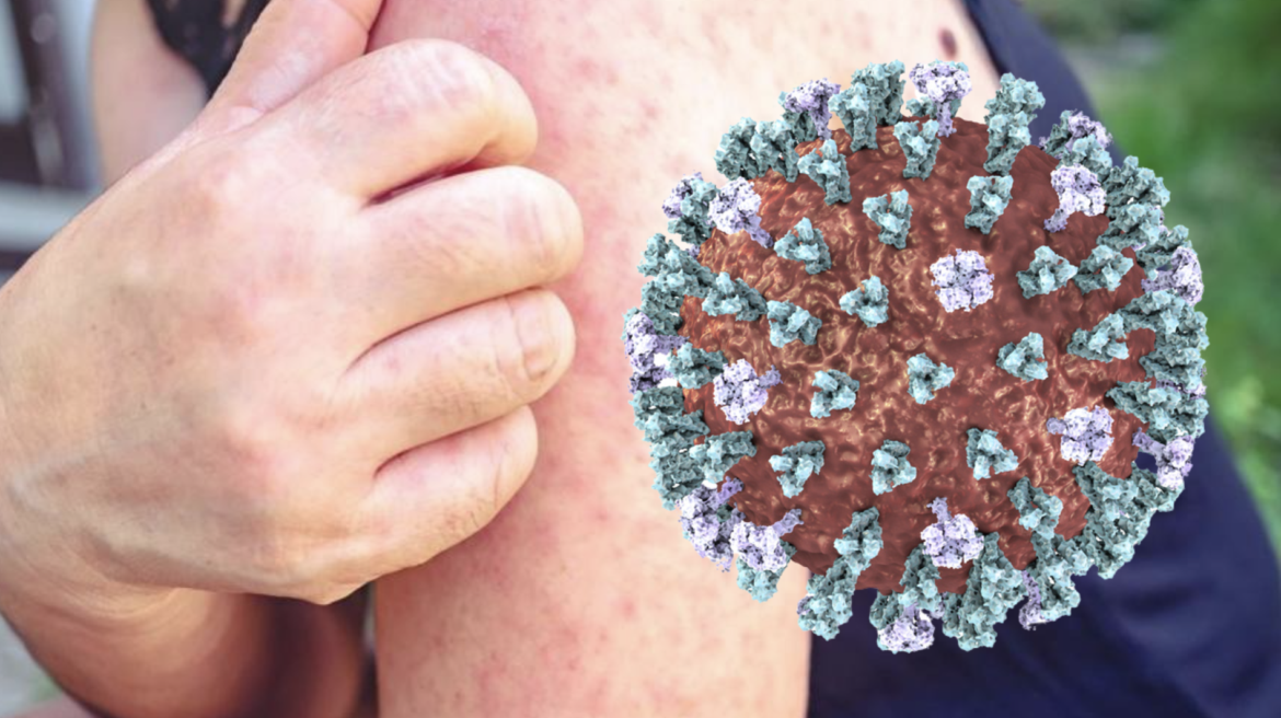 sarampión en Houston