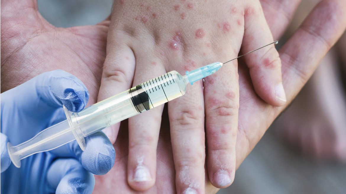 VACUNAS SARAMPION Ofrecen vacunas gratis en Houston para niños y adultos 2025