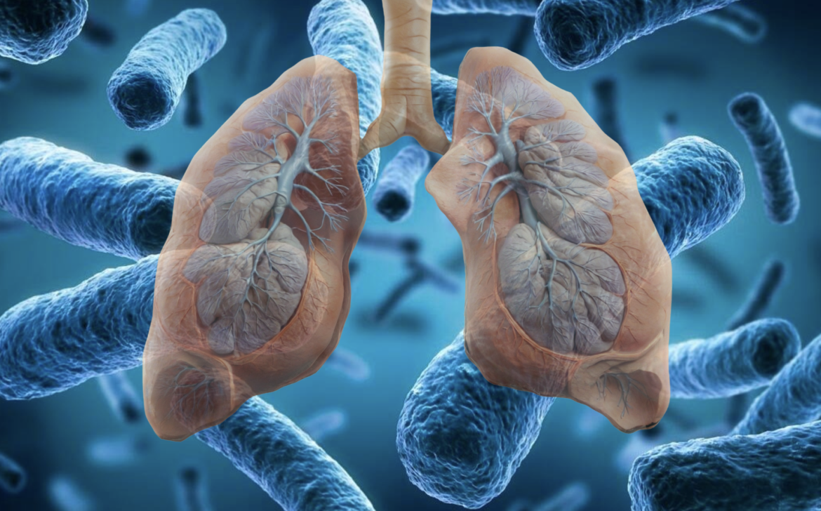 legionelosis 2025 LPH Brotes de legionelosis en Texas: lo que debes saber en 2025